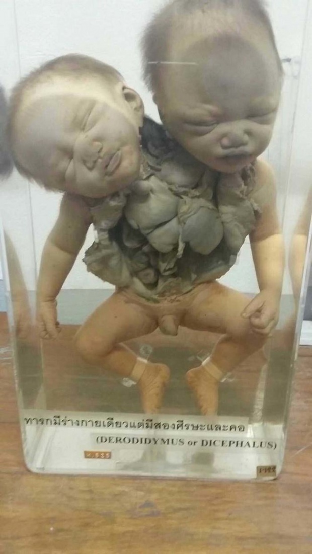 พิพิธภัณฑ์การแพทย์ศิริราช พิพิธภัณฑ์ที่แฝงความน่ากลัวในไทยที่โด่งดังถึงเมืองนอก