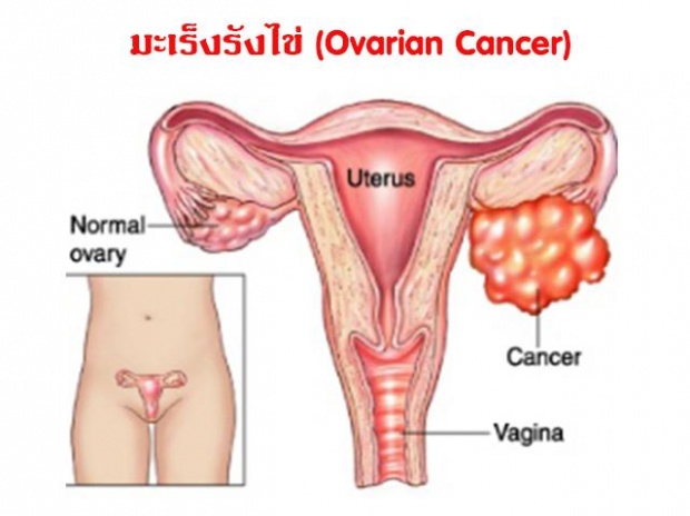 พฤติกรรมเสี่ยงและวิธีป้องกัน มะเร็งรังไข่ ภัยร้ายของผู้หญิง!!