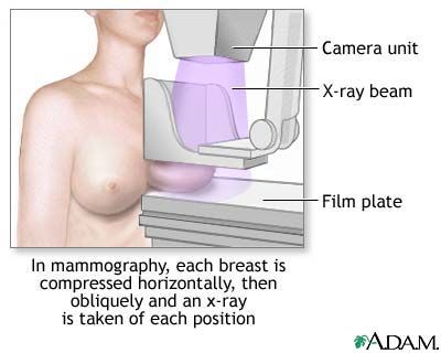 แนวทางปฏิบัติใหม่ เกี่ยวกับการตรวจโรคมะเร็งทรวงอก หรือ mammogram 