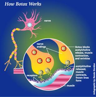 โปรตีนโบท็อกซ์ทำงานด้วยการแย่งจับกับสารสื่อประสาท