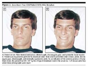 ลักษณะ ใบหน้าแบบหน้ากาก ของผู้ป่วยรายหนึ่งที่ได้รับโบท็อกซ์จากธรรมชาติ