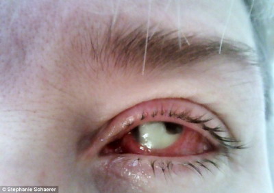 อุทาหรณ์...หญิงวัย 42 ปีใส่คอนแทคเลนส์จนติดเชื้อราทำตาบอด