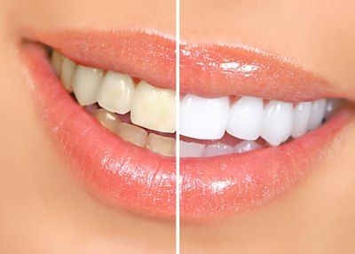 3 วิธีแก้ไขฟันเหลืองอย่างได้ผล 