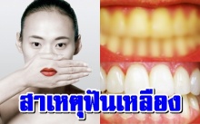 “ฟันเหลือง” สาเหตุที่แท้จริงคืออะไร+แนวทางแก้ไข