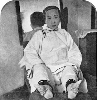 เท้าดอกบัว ( Foot Binding ) 