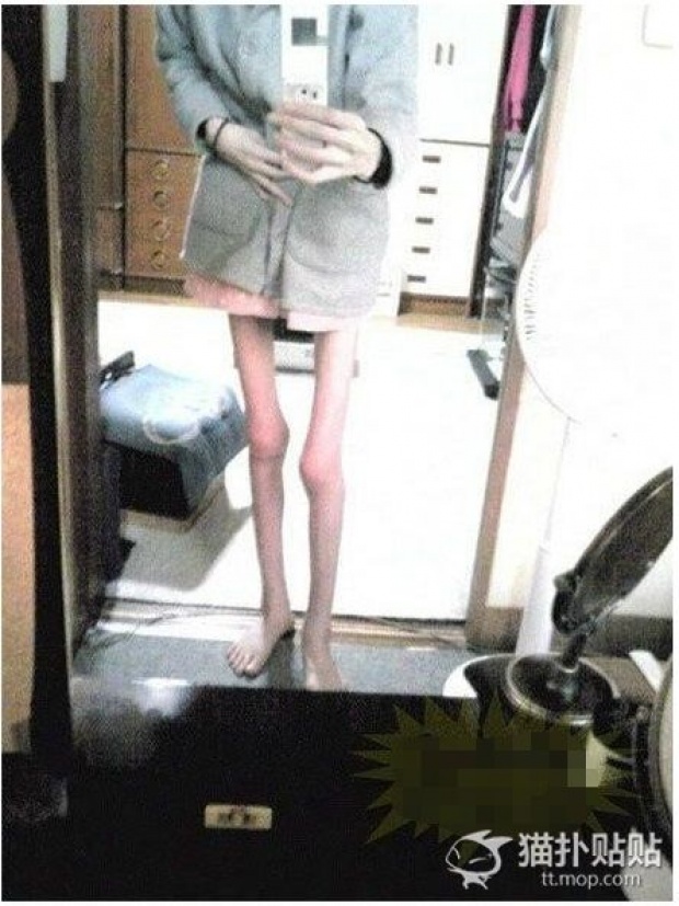 ภาพสุดสะพรึง!! สาวจีนวัย 23 คลั่งผอม หนักแค่ 26.9 กก.