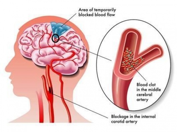  “โรคเส้นเลือดในสมองตีบ” ภัยใกล้ตัวที่อาจเกิดขึ้น โดยไม่ทันตั้งตัว (คลิป)