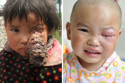 แพทย์จีนช่วยเด็กป่วยเนื้องอกใหญ่ที่ดวงตา