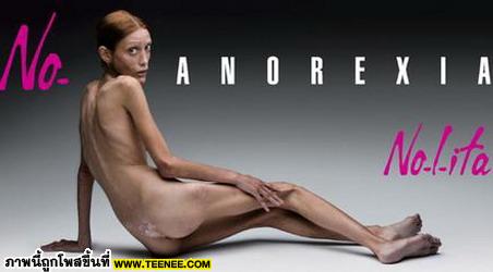 Anorexia