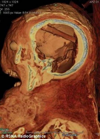 ฮือฮา พบอุปกรณ์คว้านสมองมัมมี่อียิปต์เป็นครั้งแรก อายุกว่า 2,400 ปี