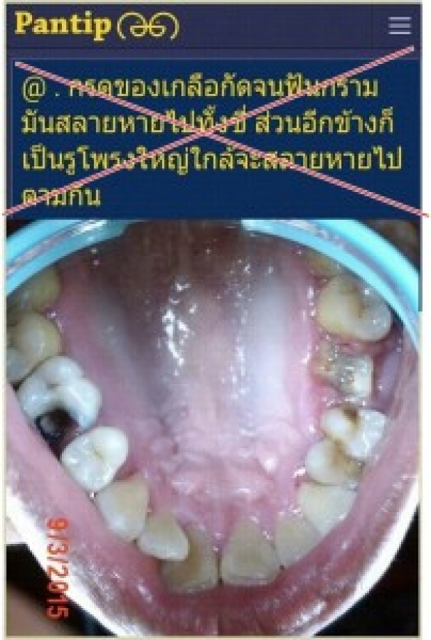 ระวัง!!! อมเกลือเพื่อทำความสะอาดฟัน อันตรายกว่าที่คิด