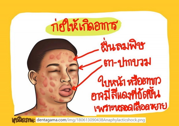  ‘แพ้อาหาร’ดัดจริตจริงดิ!  อธิบายด้วยภาพ เข้าใจได้ง๊าย ง่าย!