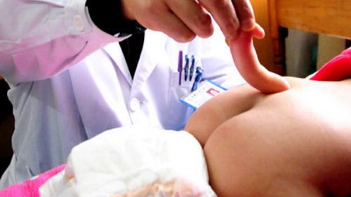ประหลาด!! เด็ก 4 เดือนมีหาง แพทย์จีนผ่าตัดสำเร็จ