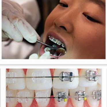 ทันตกรรมจัดฟันคืออะไร 
