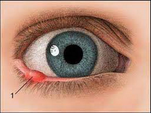 หนองในตา วิธีง่ายๆโดยไม่ต้องผ่าตัด
