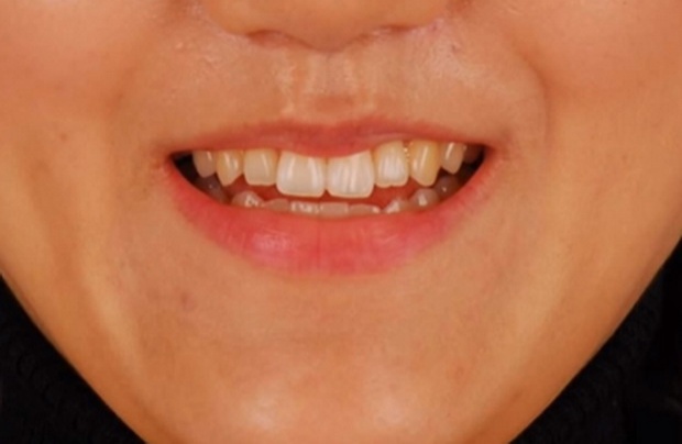 ศัลยกรรมให้ปากยิ้ม! เกาหลีพัฒนาไปไกล ถึงไม่ยิ้มก็ทำให้เหมือนคนยิ้มตลอดเวลาได้
