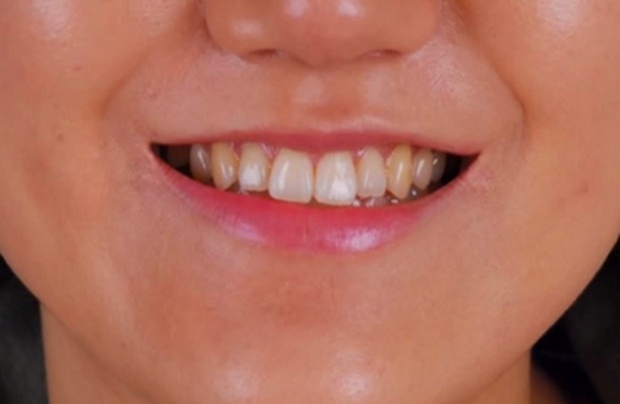 ศัลยกรรมให้ปากยิ้ม! เกาหลีพัฒนาไปไกล ถึงไม่ยิ้มก็ทำให้เหมือนคนยิ้มตลอดเวลาได้