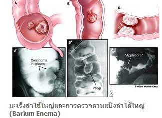 ภัยเงียบ...มะเร็งลำไส้ใหญ่......