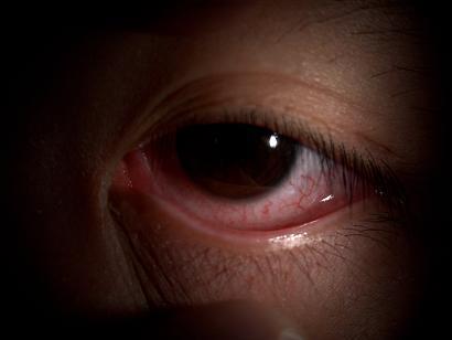 พบเชื้อตาแดง ตัวใหม่ อันตรายถึงขั้นตาบอด