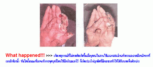 โปรดระวัง!! เจลทำความสะอาดมือ