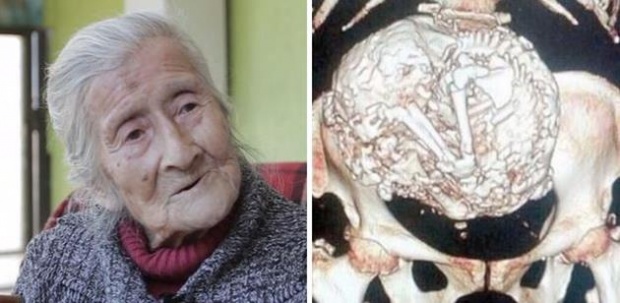คุณยายวัย 91 ปี ปวดท้องมาก แต่พอแพทย์ตรวจก็พบว่า ในท้องกลายเป็นแบบนี้