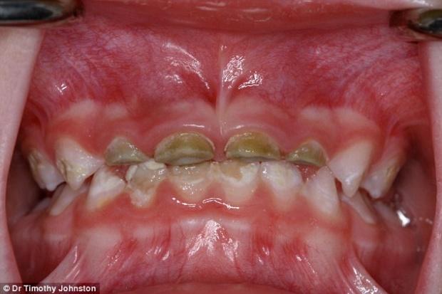 เสียวฟัน!!สภาพช่องปากของเด็กที่กินของหวานแล้วไม่รักษา