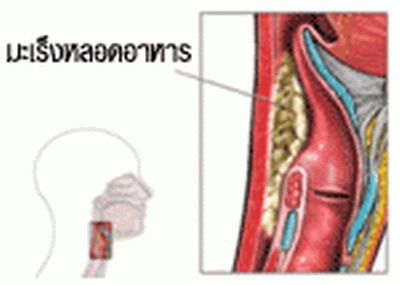 มะเร็งหลอดอาหาร