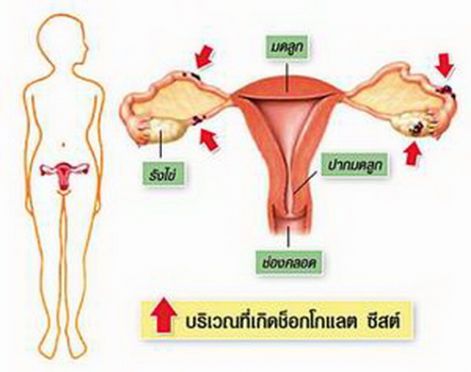 โรคช็อกโกแลตซีสต์ เพื่อสุขภาพของตัวคุณเอง