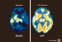 ภาพที่แสดงให้เห็น ความแตกต่างระหว่าง สมองคนปกติ และ คนที่มีเกณฑ์ ฆ่าตัวตาย....