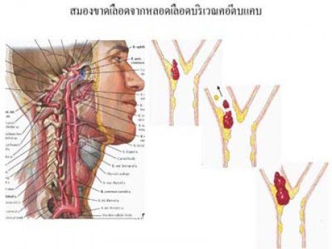 หลอดเลือดในสมอง ตีบ แตก ตัน