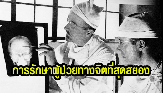 Lobotomy การรักษาทางการแพทย์ที่โคตรจะสุดสยอง ใช้รักษาผู้ป่วยทางจิต โหดยังไงไปดูกัน