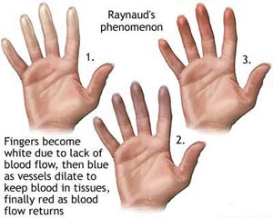 โรคหนังแข็ง (scleroderma)