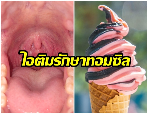 ทอนซิลอักเสบให้กินไอติม!?