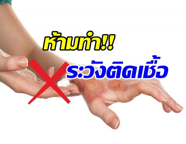 ยืนยัน! ยาสีฟันไม่ช่วยรักษาแผลไฟไหม้น้ำร้อนลวก แถมเสี่ยงติดเชื้อ ทำลายเนื้อเยื่อ