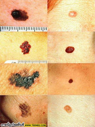 รู้จักมะเร็งผิวหนัง(skin cancer)