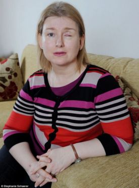 อุทาหรณ์...หญิงวัย 42 ปีใส่คอนแทคเลนส์จนติดเชื้อราทำตาบอด