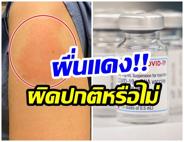 รู้จัก COVID Arm อาการไม่พึงประสงค์หลังฉีดวัคซีนชนิด mRNA