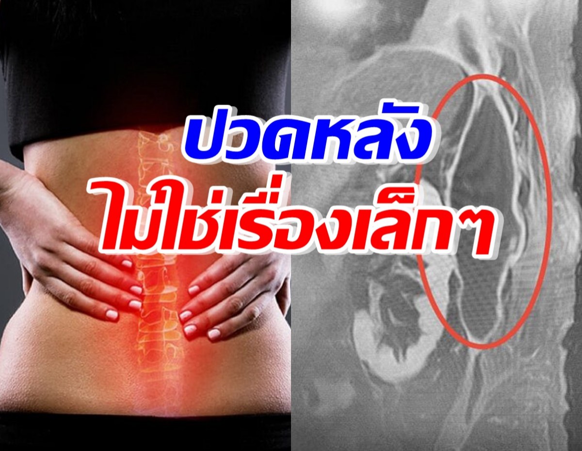 ปวดหลังเรื้อรังไม่ใช่เรื่องเล็ก สุดท้ายตรวจเจอโรคร้ายแรง