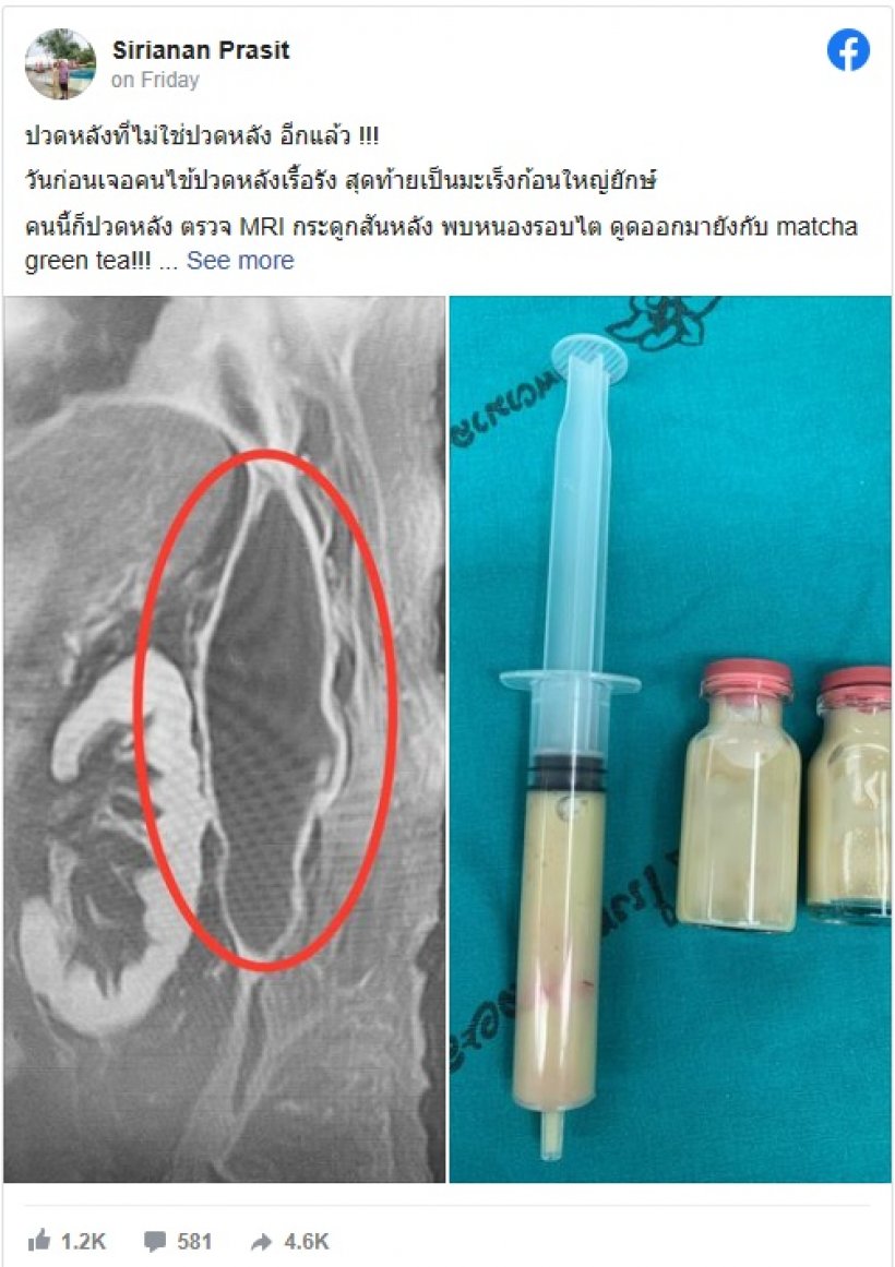 ปวดหลังเรื้อรังไม่ใช่เรื่องเล็ก สุดท้ายตรวจเจอโรคร้ายแรง