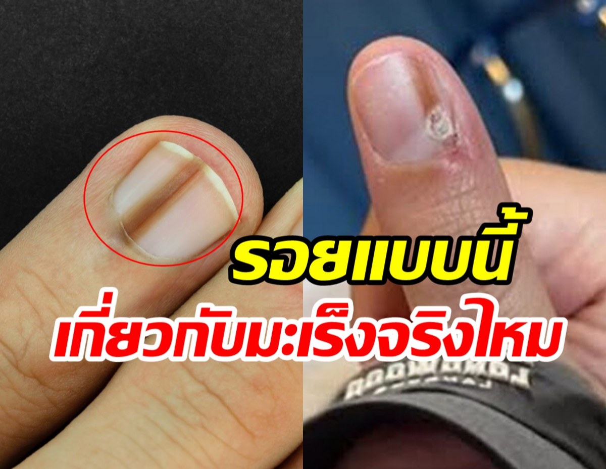 ไขข้อสงสัย รอยขีดบนเล็บ ใช่สัญญาณเตือนมะเร็งหรือไม่?