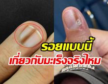 ไขข้อสงสัย รอยขีดบนเล็บ ใช่สัญญาณเตือนมะเร็งหรือไม่?