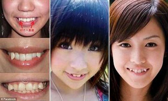 สาวญี่ปุ่นฮิตเติมฟันเขี้ยว-เชื่อยิ้มน่ารักขึ้น