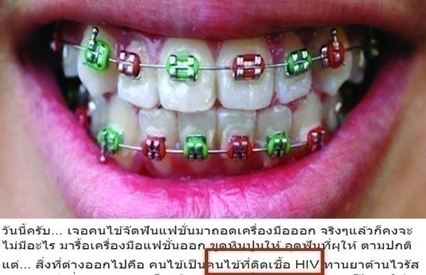 หมอฟันเล่าเรื่องชวนช็อก!! เจอคนไข้จัดฟันเถื่อนป่วยติดเชื้อ HIV !!