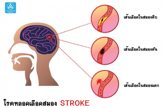 รู้ก่อนเป็น! โรคหลอดเลือดสมอง อันตรายถึงชีวิตอันดับ3ของไทย