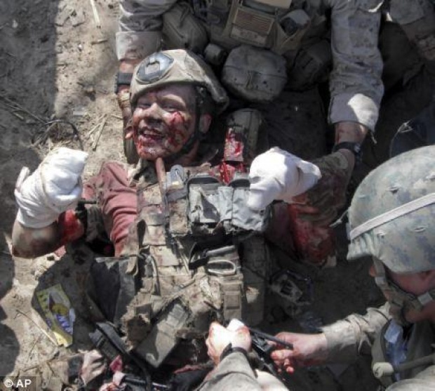 ยังยิ้มได้!!! ทหารโดนระเบิดขาขาด แต่ยังมีรอยยิ้มเป็นกำลังใจให้คนนับล้าน