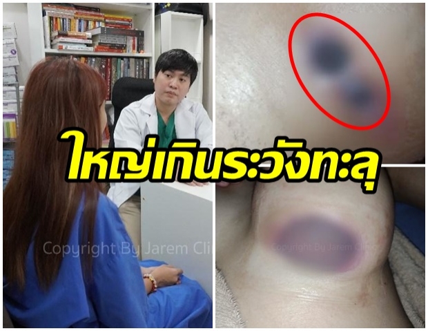 อ่านก่อนทำ เเพทย์เตือนสาวๆ เสริมหน้าอกใหญ่ไประวังซิลิโคนทะลุ 