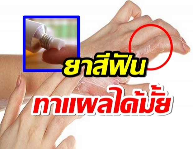 ที่นี่มีคำตอบ ... น้ำร้อนลวก-เเผลไฟไหม้ ใช้ยาสีฟันทาได้หรือไม่ 