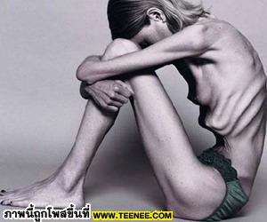 Anorexia