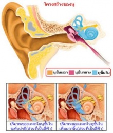 โรคน้ำในหูไม่เท่ากัน