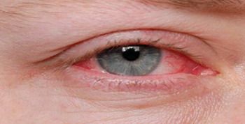 พบเชื้อราตัวใหม่ต้นเหตุ “ตาแดง” ร้ายแรงถึงขั้นทำให้ตาบอด